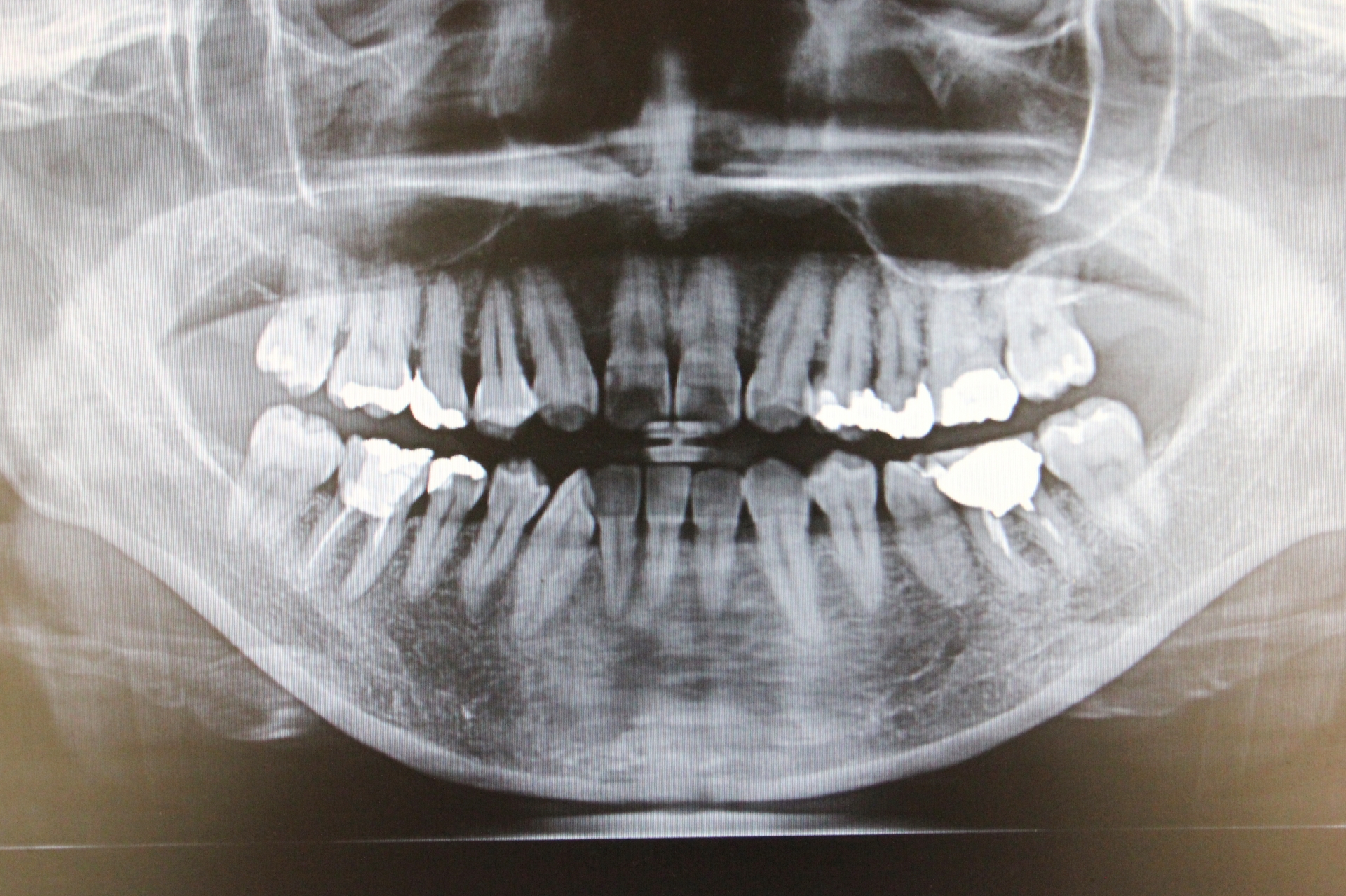 歯全体のレントゲン