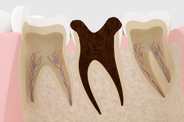 歯の神経を取った方がよいケース