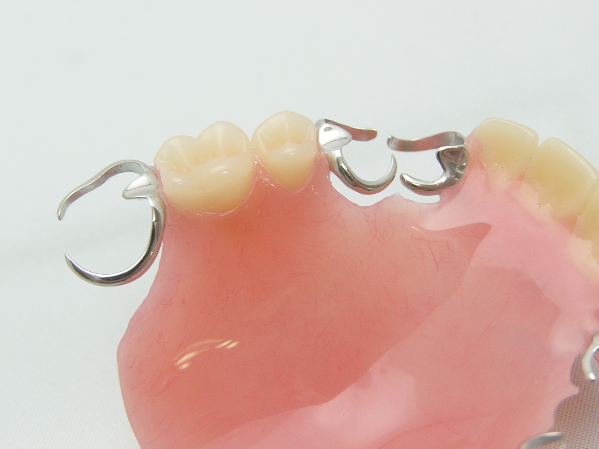 部分入れ歯の種類は?目立たないものを保険適用で作ることはできる? - 歯医者DOC