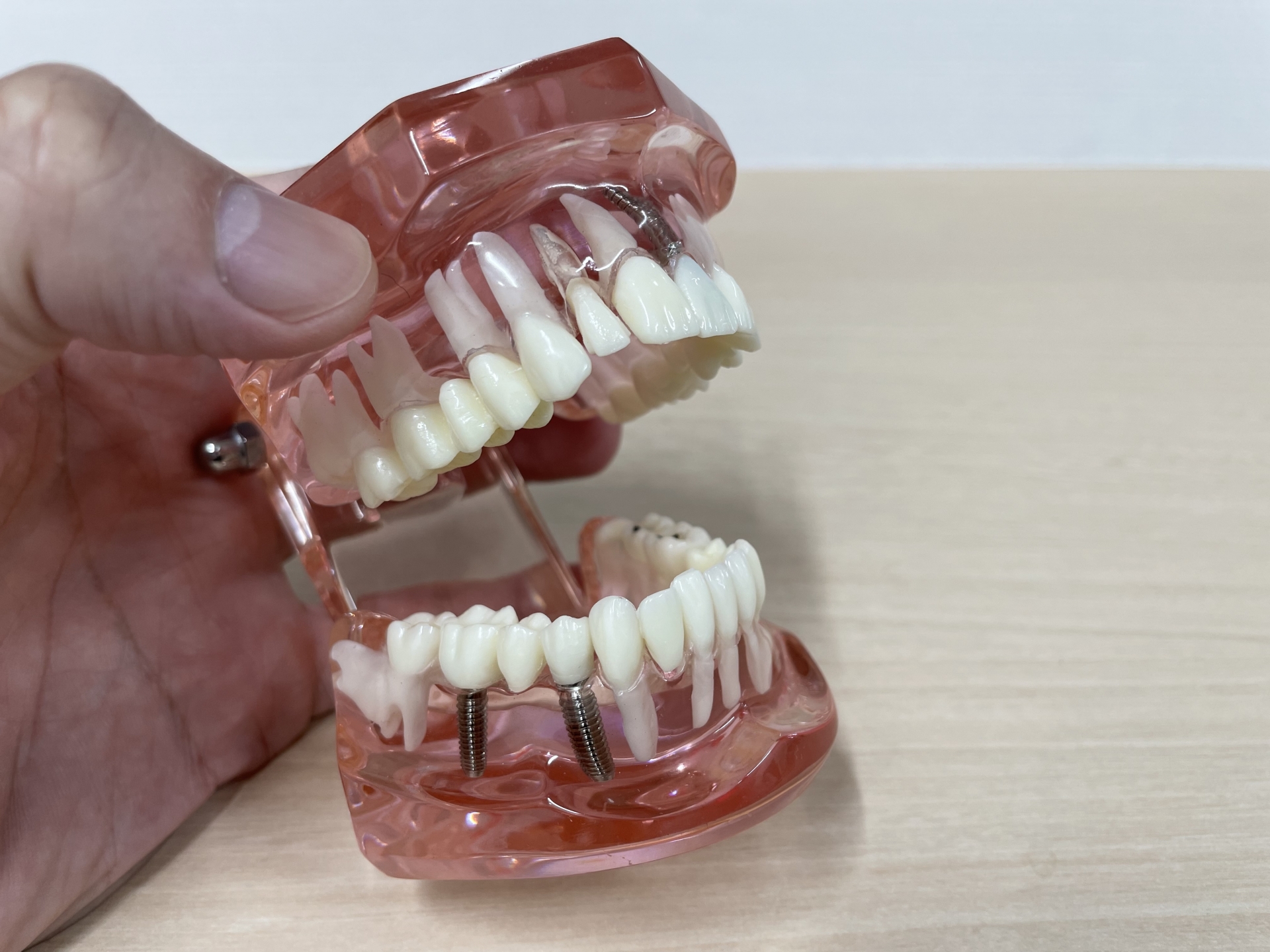 歯の模型・半開口・前斜め