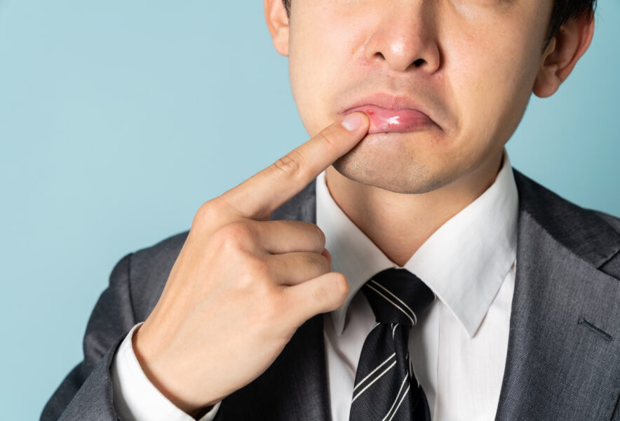 粘液嚢胞とは？一般歯科で受けられる治療法を徹底解説