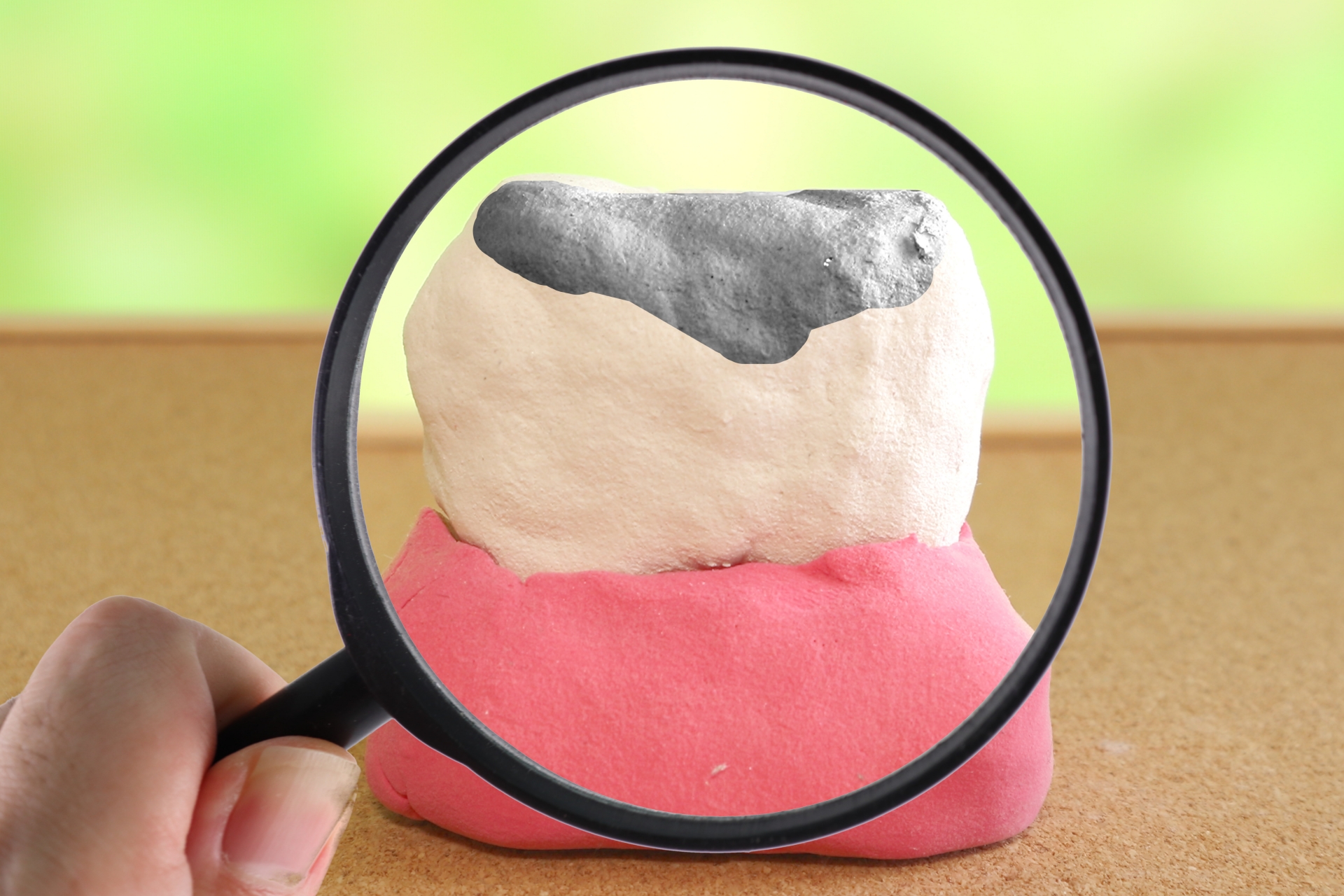 むし歯治療について