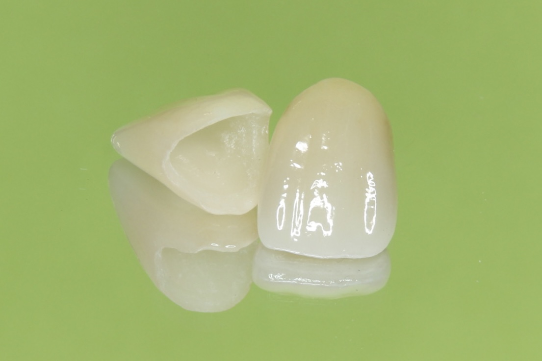 セラミック治療について