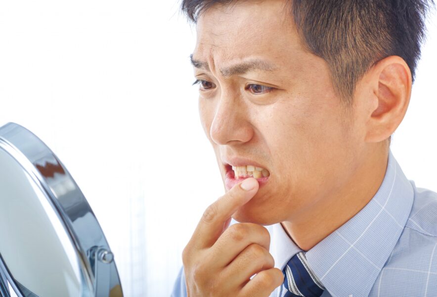 差し歯の歯の裏が黒い原因は？治療法や歯茎の黒ずみを予防するためのポイントを解説