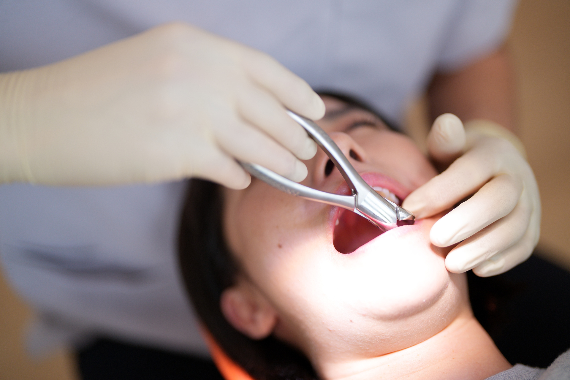 親知らずの抜歯